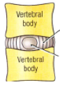 What is an intravertebral (IV) disk composed of?