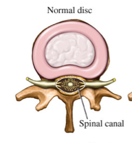 herniated disk (clinical correlate)