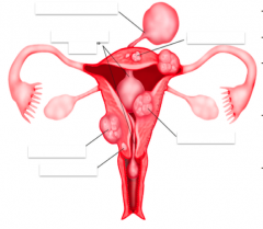 *benign tumors in the uterus
*highly variable and common (25% of women in life)
*often assymptomatic, except in pregs