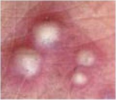 Pus-filled papule 


Circumscribed elevation of skin containing purulent fluid of variable character (i.e., fluid may be white, yellow, greenish or hemorrhagic)