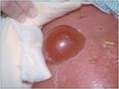 A cyst larger than 1cm in size