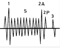 bandförmiges Systolikum mit P. m. über der Herzspitze, Fortleitung in die Axilla, leiser 1. Herzton, weit gespaltener 2. Herzton, evtl. 3. oder 4. Herzton