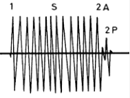 holosystolisches Geräusch („Pressstrahl“) mit P.m. über Erb, „Graham-Steel“-Geräusch (Diastolikum im 2. ICR links parasternal) bei großem VSD (Pulmonalinsuffizienz)