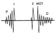 diastolisches Decrescendogeräusch mit P.m. über der Herzspitze, paukender 1. Herzton und gespaltener 2. Herzton, Mitralöffnungston, präsystolisches Crescendogeräusch bei erhaltenem Sinusrhythmus, Graham-Steel-Geräusch bei Pulmonalinsuffizien...