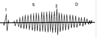 systolisch-diastolisches Crescendo-Decrescendo-Geräusch („Maschinengeräusch“) mit P.m. 2. ICR links infraklavikulär