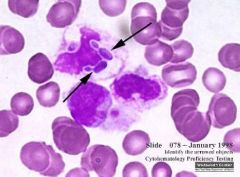 Clinical Hematology (Microscopic Images) Flashcards - Cram.com