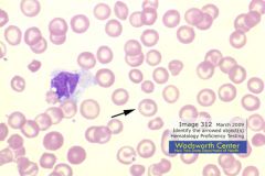 Clinical Hematology (Microscopic Images) Flashcards - Cram.com