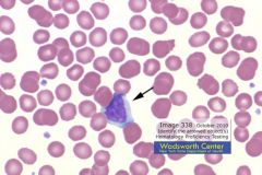 Clinical Hematology (Microscopic Images) Flashcards - Cram.com