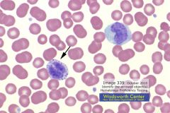 Clinical Hematology (Microscopic Images) Flashcards - Cram.com