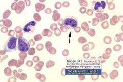 Clinical Hematology (Microscopic Images) Flashcards - Cram.com