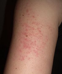 follicular keratosis, chicken skin, red bumps on the dorsum of the skin and the back, this is a type of eczema