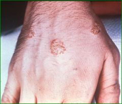coin shaped lesions usually on the dorsum of the hands and arms,seen in older patients it is often secondary to an underlying tinea infection referred to as a dermatophytid reaction, treating the underlying fungal infection(clotrimazole) will help...
