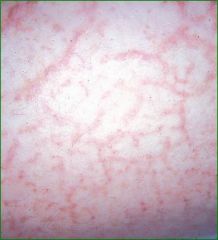 eczema craquele,appearance of cracked porcelain, seen in older patients,essentially excessively dry skin, treated with keratolytic agents such as 12% lactic acid, 10% or 20% urea cream or glycolic acids, emollient use, the greasier the better, H1 ...