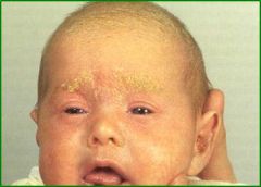 “cradle cap” in infants and dandruff in adults, Infants usually grow out of the rash by 9 months, the scalp, eyebrows, eyelashes, beard and mustache area, behind the ears the v of the chest and the groins, can also go to the forehead and in th...