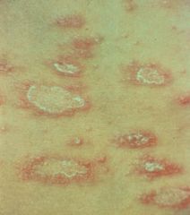 maculopapular, red, scaling, eruption, herald patch(bigger than the others and erupts first), fine scaling, oval maculates w/marginal collaterette, "christmas tree" pattern, mimics syphillis so run RPR, palliative care with topical steroids and an...