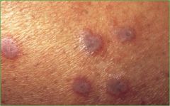 acute or chronic inflammation of the skin and mucous membranes, pruiritic, purple, papules, planar, polygonal, wrist, lumbar area, shins, scalp, eyelids, groin, nails, 40% papules w/white reticulate lesions on the buccal mucosa, usually resolves o...
