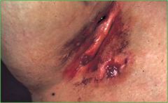 chronic inflammatory scarring disease related to apocrine sweat glands, axilla, inguinal, perianal and inframammary areas, intralesional triamcinolone 5-10mg/ml, I&D, minocycline, ciproflaxican, cephalosporins, clindamycin, accutane 1mg/kg, surgic...