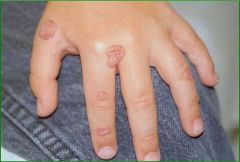 Human Papilloma Virus, school age children, decreases after 25, firm papules, hyperkeratotic, clefted surface, vegetations, site of trauma, biopsy, HPV subtyping, :  Salicylic acid and/or lactic acid in collodion, curettage, surgical or laser exci...