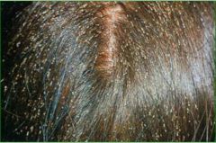 Over-the-counter treatment:
topical pyrethrin with piperonyl butoxide (Rid)
Prescription treatments:
permethrin (5% Elimite, 1% Nix) 
topical sulfur
lindane (Kwell)
malathion (Ovide)
crotamiton (Eurax)
Remove nits using a special comb 
Sa...