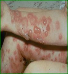Onset >60 years of age
Pruritic skin lesions
Tense blisters
Oral mucous membrane lesions in 10-35%
Self-limited in many cases
Treatment with oral glucocorticoids alone or with azathioprine, also dapsone, tetracycline, niacinamide