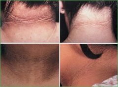 Hyperpigmentation and thickening of the skin of the neck and in body folds; appears “velvety”
Skin markings are accentuated
Paraneoplastic AN can involve palms/soles and vermillion border of the lips
Classification:
Type 1 - hereditary, be...