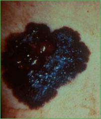 Account for 70% of all melanomas, 30 - 50 years, Slightly higher in females, Evolves over a period of 1 - 5 years, excisional biopsy is treatment