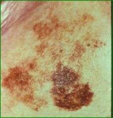 Synonymous with Hutchinson’s nevus, Hutchinson’s freckle, melanoma in situ, Flat, macular, intraepidermal neoplasm and the precursor or evolving lesion of Lentigo Maligna Melanoma (LMM), median age 65, Older population with increased sun exposure
