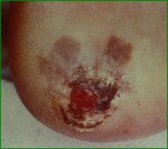 Account for 2 to 8% of all melanomas; evolves over 2.5 years, Median is 65 years, Male:Female ratio - 3:1, ALM is the principal melanoma in American and African Blacks; accounts for 50 - 70% of melanomas in Japanese population, Survival rates for ...