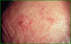 Single or multiple, discrete, dry, rough, adherent, scaly lesions on habitually sun-exposed skin, Usually middle age, More common in males, skin phototypes I, II, III, Rare in IV , Almost never in V or VI, Outdoor workers, sportspersons and sun wo...