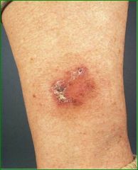 Usually a solitary lesion on exposed skin, Slowly enlarging, erythematous macule, sharp border, little or no infiltration, usually slight scaling, some crusting, excision, Moh’s surgery in difficult sites, Cryotherapy, Efudex, Imiquimod, Mortali...