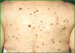 skin colored to brown to black, discrete, raised, rough or hyperkeratotic, papules to plaques, often verrucous,
greasy “stuck on” appearance, sebaceous areas: face, back, chest, groin, Completely benign, Common, middle age-elderly, higher in ...