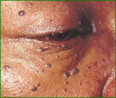 2-3mm, brown to black, hyperkeratotic, pedunculated or verrucous papules, cheeks, around eyes bilaterally, Completely benign, teens to middle age, hereditary, more common in Blacks and Hispanics, Origin
equivalent to seborrheic keratosis, Liquid ...