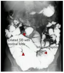 Radiographic features of coeliac sprue: