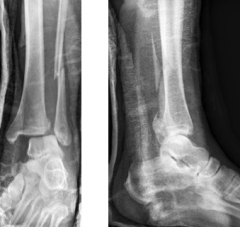 What fixation method will provide the best type of rotational stability for the fracture pictured?