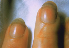 










Splinter hemorrhages beneath the nails