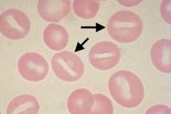 1) No Rh antigens at all


2) Hemolytic anemia with stomatocytes