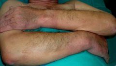 What are the systemic findings in scleromyxedema?