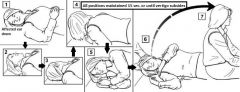 Horizontal canalithiasis
F/u with forced prolonged position (FPP); Pt lies in sidelying with affected ear up 8-12 hours
Same, but with rapid movements