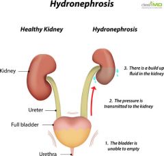 Urine backs up into kidney, increasing hydrostatic pressure, causing kidney damage