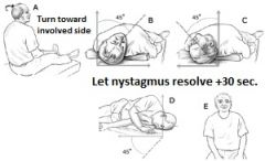 Epley maneuver (canalith repositioning)