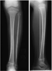 23mo G refuses to WB s/p falling on the playground yesterday, is afebrile WBC (ESR) are w/in nl limits. On PE= leg has no erythema, but does have mild tenderness along the distal tibial shaft. xrays=(-). What is the management?  1.  vit D & ca; 2-...