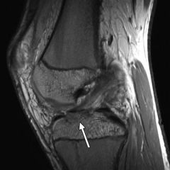 19yo pt is undergoing an arthroscopic tx of a R knee with suture fixation via transosseous tunnels Tibial Eminence Fx. What is the most likely postop complication? 1-Infection; 2-Arthrofibrosis; 3-Spontaneous osteonecrosis of the knee (SONK); 4-Ha...