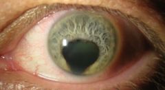 aut dom
ALWAYS INFERIOR

key appearance of iris; in lid, manifests as cleft

CHARGE association