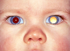 retinoblastoma
cataract

retinal detachment
retinopathy of prematurity

larval granulomatosis
