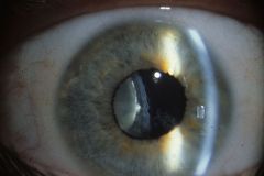 trauma = #1
uveitis
congenital glaucoma
cataract

systemic =
1. marfan
2. homocystinuria
3. ehlers