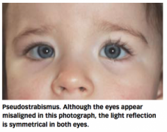 epicanthal folds and broad nasal bridge

caused by unique facial characteristics of infant
