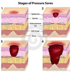 1) Stage 1 - redness after pressure removed
2) Stage 2 - damage to, but not thru dermis
3) Stage 3 - damage thru dermis into SubQ fat
4) Stage 4 - damage beyond fascia into underlying muscle, bone, ligament, tendon