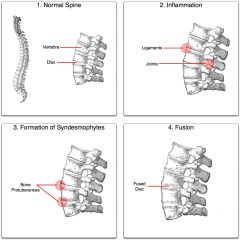 1. Inflammation with fibrosis and ossification of ligaments, tendons and insertions2. Formation of syndesmophytes (bony growth originating in ligaments) and microfractures causing "Bamboo spine"
3. Fusion of the spine