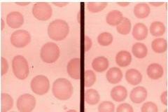 Describe the RBC morphology of the cells on the LEFT.