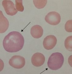Describe the RBC morphology of the indicated cells.